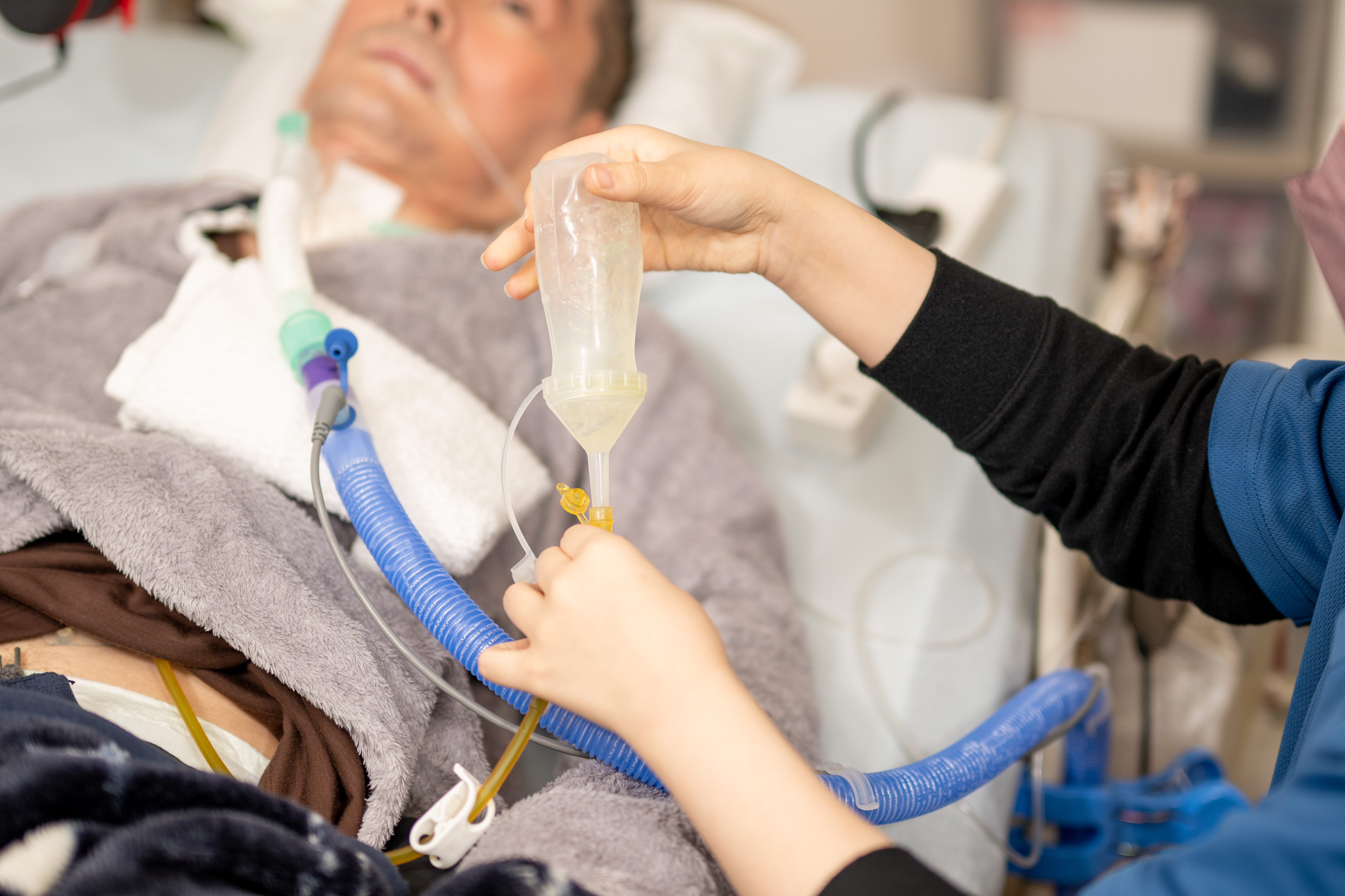 胃ろうイラスト